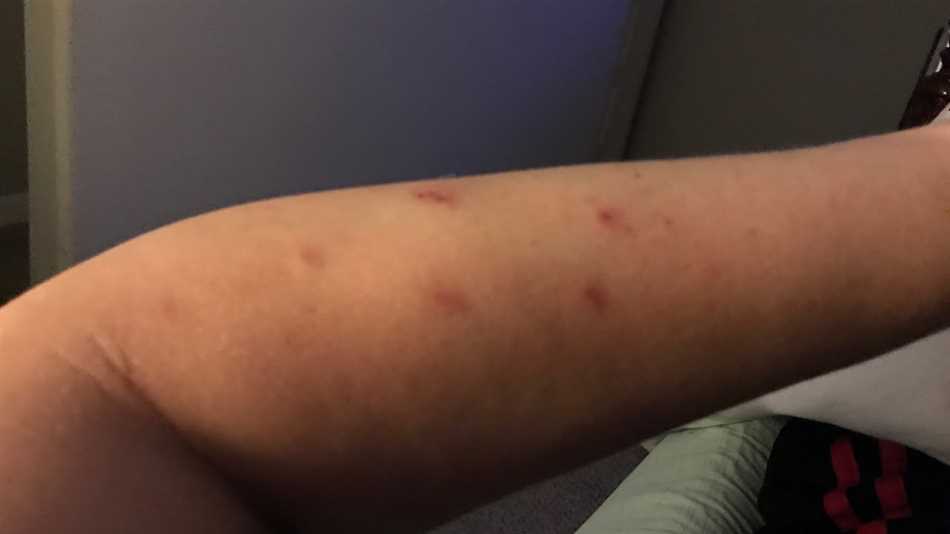 Amitriptyline for brachioradial pruritus