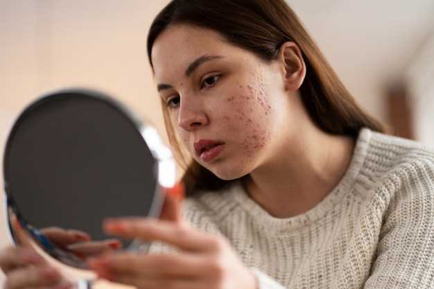 Does doxycycline treat rosacea
