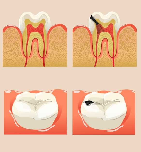 Doxycycline for aggressive periodontitis