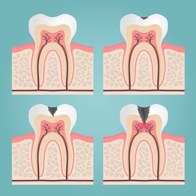 Doxycycline tooth abscess