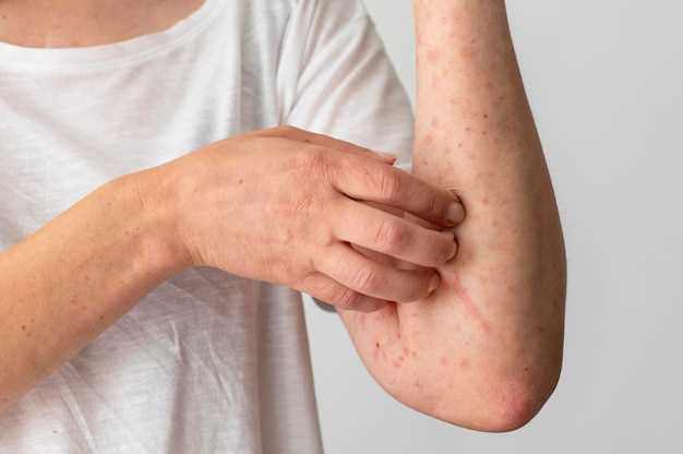 Images of doxycycline rash