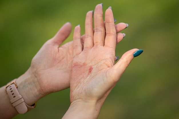 Raynaud's disease clonidine