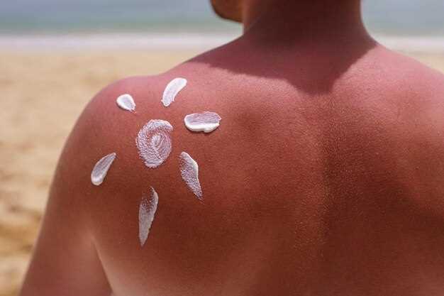 Sunburn after doxycycline