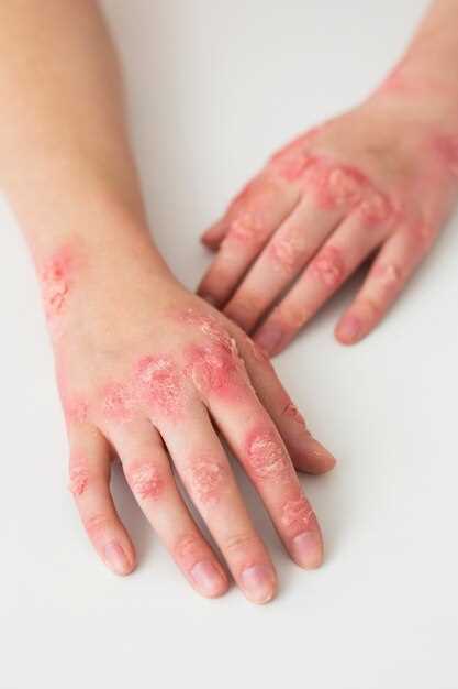 Systemic lupus erythematosus doxycycline